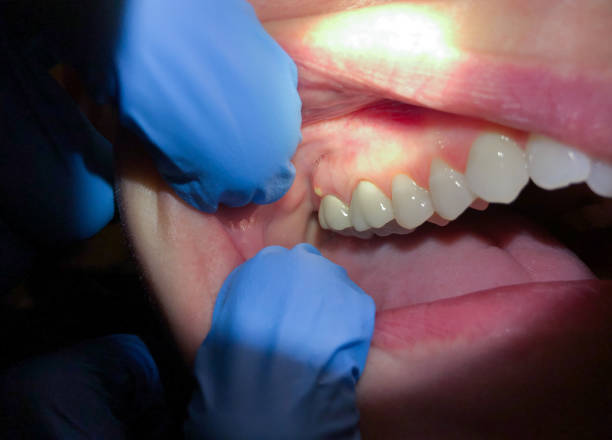 Best Urgent Care for Lost Fillings or Crowns in East Dublin, GA