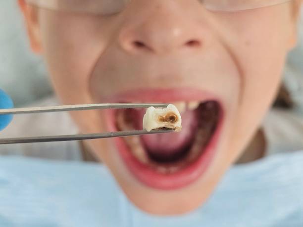 Best Emergency Root Canal Treatment in East Dublin, GA